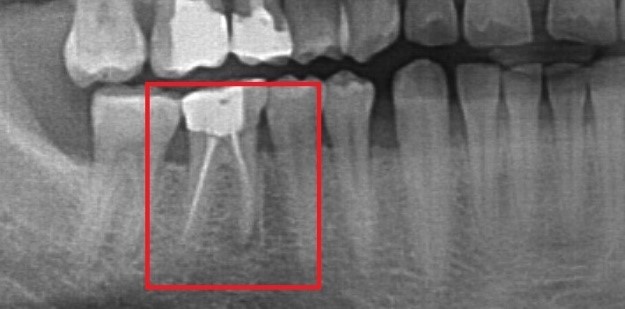 Koferdamo sistema endodontiniam gydymui